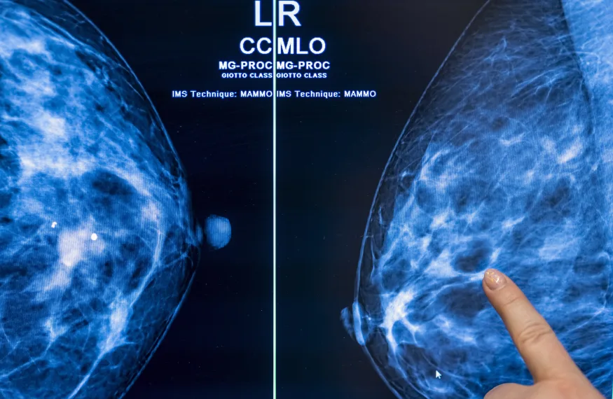 Kræftscreening med kunstig intelligens kan halvere radiologernes arbejdsbyrde - studie