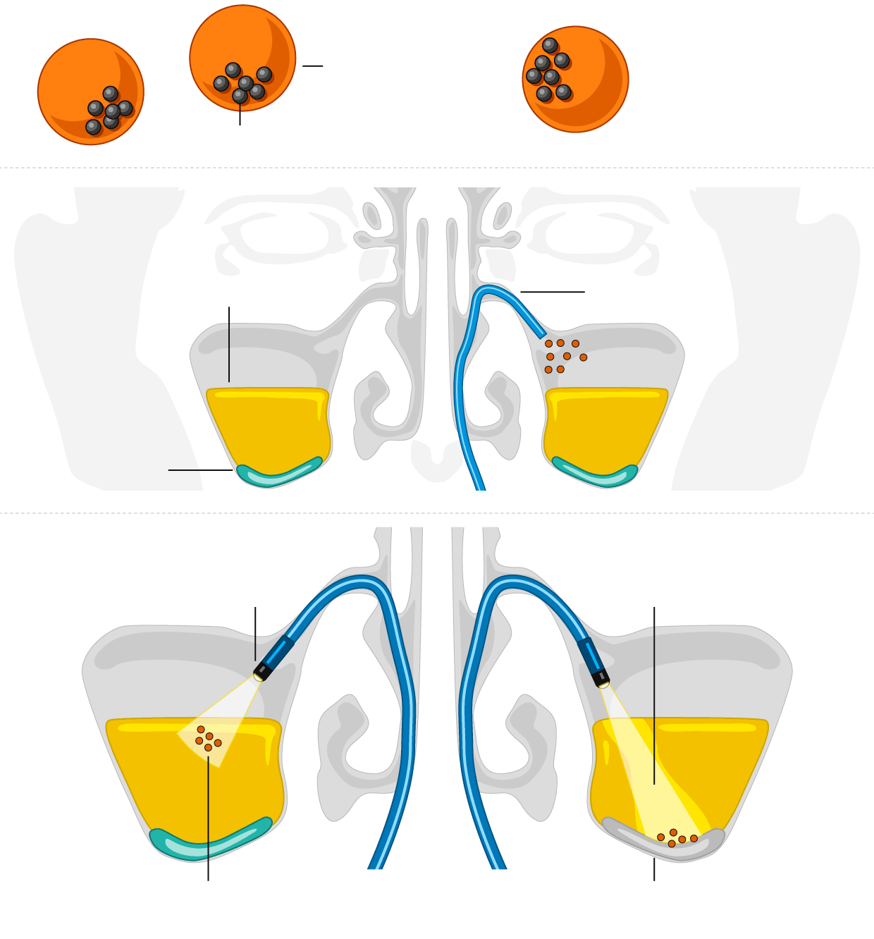 Illustration af mikrorobotter til behandling af bihulebetændelse